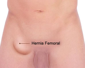 Cirugía de Hernia Femoral en Puebla