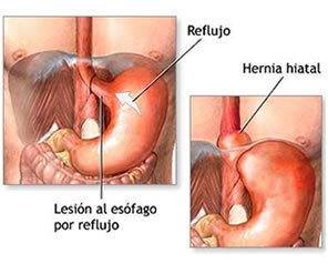 Cirugía de Hernia Hiatal en Puebla
